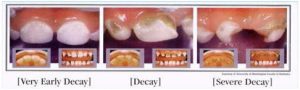 stages of decay