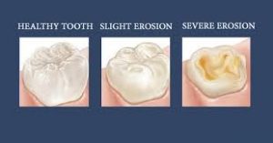 tooth erosion occl