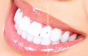 Teeth whitening sensitivity permanent