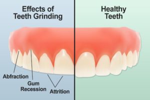 effects of teeth grinding